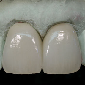 Layered Zirconia